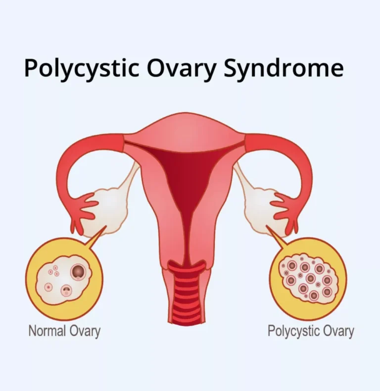 Polycystic Ovary Syndrome PCOS