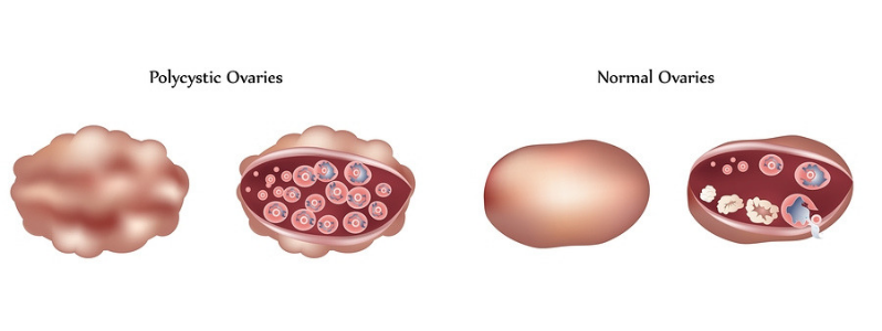 PCOS (Polycystic Ovary Syndrome)