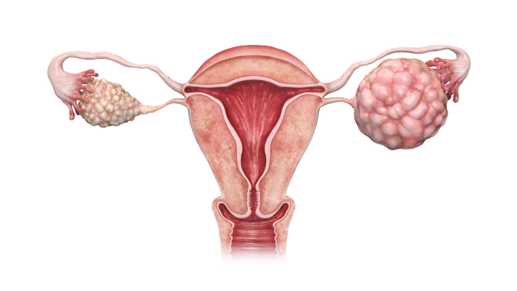 polycystic ovarian syndrome