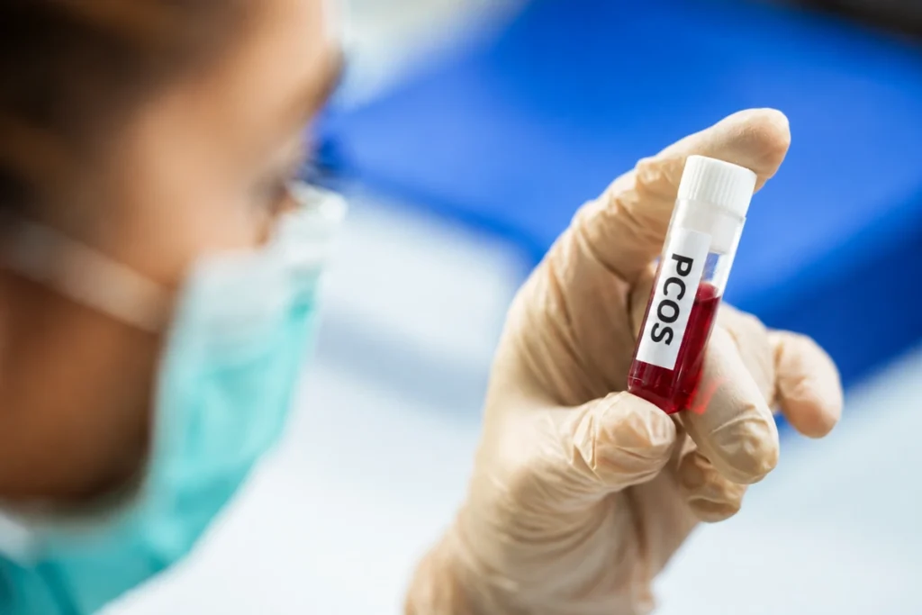 PCOS Blood Test: Blood sample being collected for PCOS hormone testing